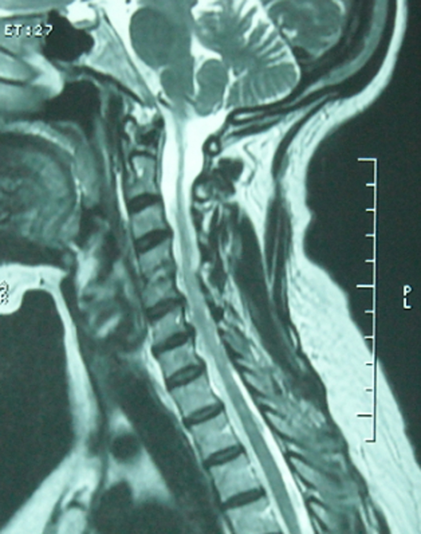 what is multifocal papillary thyroid carcinoma