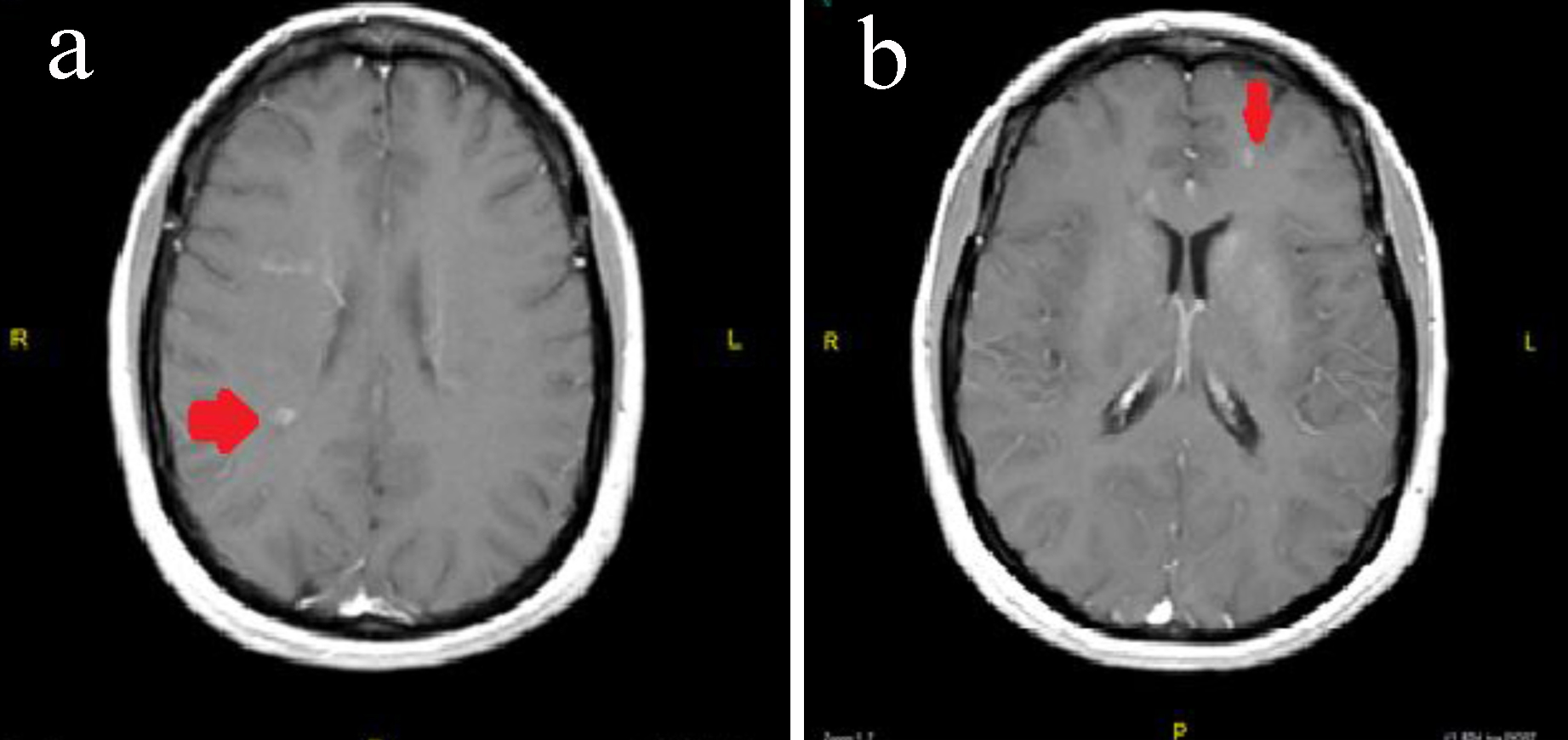 J Neurol Res