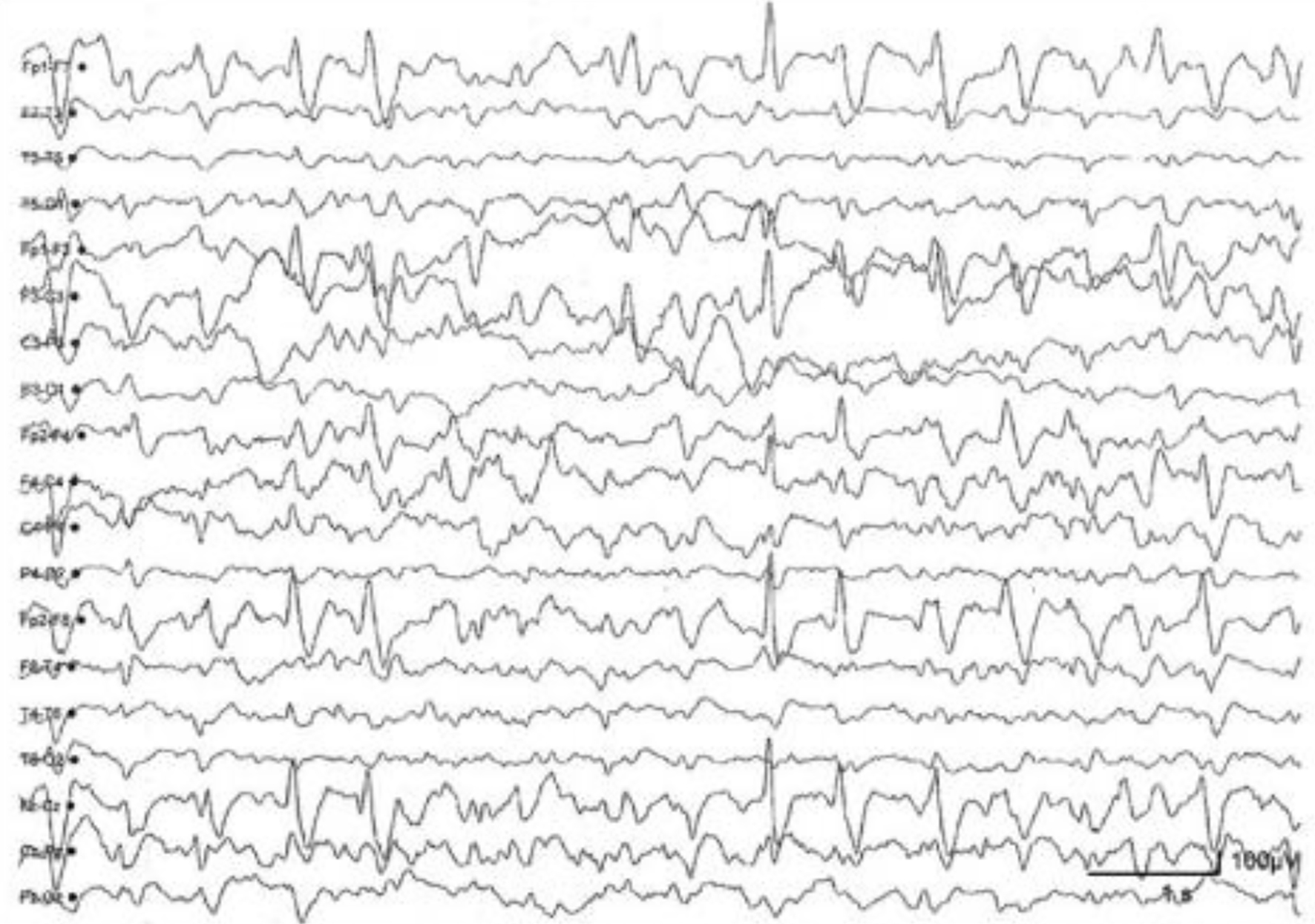 Electroencephalography During the Acute Phase Of Encephalitis: A Brief ...