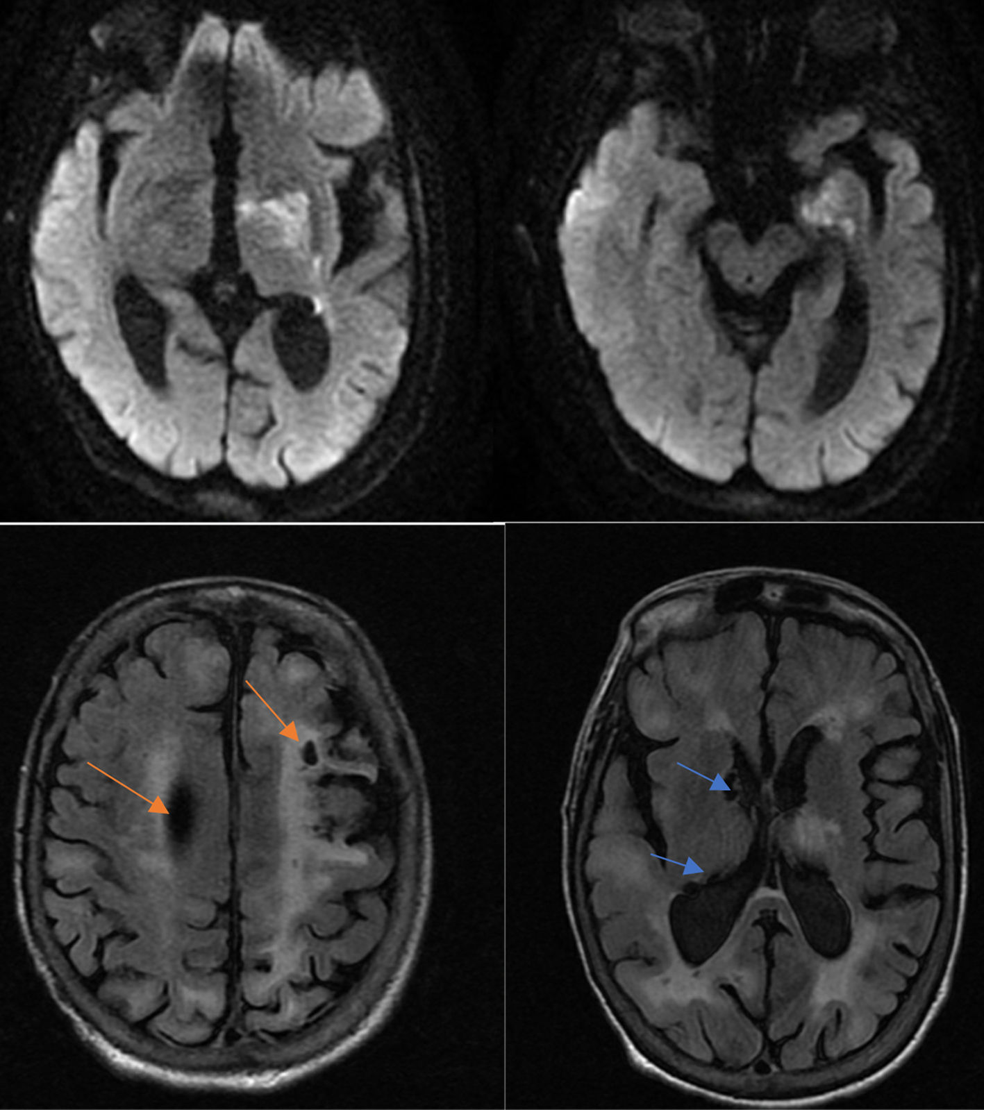 Tissue Plasminogen Activator Use in an Acute Stroke Patient